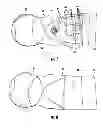 Fig. 06 - Adjustable circumferential length lumbar sacral brace