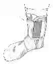Fig. 01 - Ankle stabilizing device comprising an above-the-foot body member and integrated flexible non-stretch ankle belt