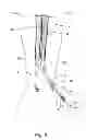 Fig. 04 - Devices, systems, and methods for peripheral arteriovenous fistula creation