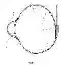 Fig. 04 - Device for facilitating intravenous needle insertion or cannulation with vacuum generation means and tourniquet fastener