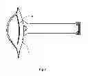 Fig. 08 - Device for facilitating intravenous needle insertion or cannulation with vacuum generation means and tourniquet fastener