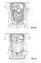 Fig. 02 - METHODS AND DEVICES FOR REMOVING OMENTAL TISSUE