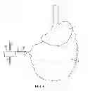 Fig. 07 - METHODS AND DEVICES FOR REMOVING OMENTAL TISSUE