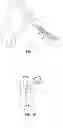 Fig. 02 - Minimally-invasive device, kit, and method for harvesting bone graft