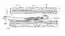 Fig. 01 - Multiple loop snare