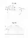 Fig. 25 - Prosthetic device, method of planning bone removal for implantation of prosthetic device, and robotic system