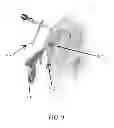 Fig. 08 - Methods for passing multiple sutures through tissue