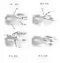 Fig. 17 - Methods for passing multiple sutures through tissue