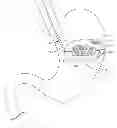 Fig. 01 - Methods and devices for deploying and releasing a temporary implant within the body