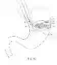 Fig. 04 - Methods and devices for deploying and releasing a temporary implant within the body