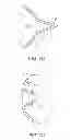 Fig. 13 - Methods and devices for deploying and releasing a temporary implant within the body