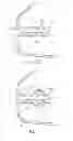 Fig. 14 - Methods and devices for deploying and releasing a temporary implant within the body