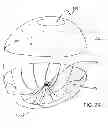 Fig. 17 - Methods and devices for deploying and releasing a temporary implant within the body