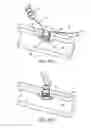 Fig. 06 - Bone anchor apparatus and method