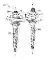 Fig. 01 - Posterior Lumbar Plate