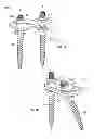 Fig. 02 - Posterior Lumbar Plate