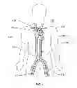 Fig. 02 - Expandable iliac sheath and method of use
