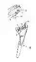 Fig. 02 - Humeral component of a shoulder prosthesis