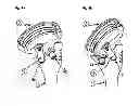 Fig. 05 - Humeral component of a shoulder prosthesis
