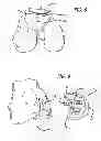Fig. 04 - Marking template for installing a custom replacement device for resurfacing a femur and associated installation method