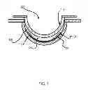 Fig. 02 - Method of forming a multi-piece insert device with seal for ophthalmic devices