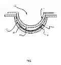 Fig. 02 - Multi-piece insert device with glue seal for ophthalmic devices