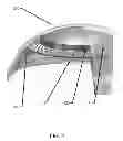 Fig. 03 - Multi-piece insert device with glue seal for ophthalmic devices