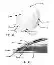 Fig. 05 - Multi-piece insert device with glue seal for ophthalmic devices