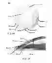 Fig. 05 - Multi-piece insert device with locking seal for ophthalmic devices