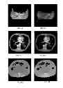Fig. 06 - Computed tomography system with dynamic bowtie filter