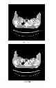 Fig. 07 - Computed tomography system with dynamic bowtie filter