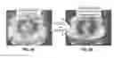 Fig. 12 - Modulating gantry rotation speed and image acquisition in respiratory correlated (4D) cone beam CT images