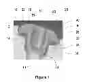 Fig. 02 - Hearing aid component with earwax filter