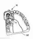 Fig. 01 - Dental Osteotomy Appliance and Preparation Method