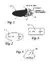 Fig. 02 - Method and device for female urinary incontinence
