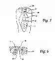 Fig. 03 - Method and device for female urinary incontinence
