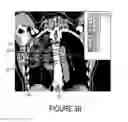 Fig. 09 - Method for Three Dimensional (3D) Lattice Radiotherapy