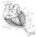 Fig. 01 - SUPPORTING A HEART