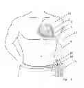 Fig. 02 - SUPPORTING A HEART