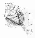 Fig. 04 - Implanting cardiac devices