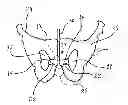 Fig. 01 - Method of treating incontinence