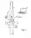 Fig. 02 - Prosthetic component for monitoring synovial fluid and method