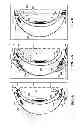 Fig. 06 - Contact lens with integrated pulse oximeter
