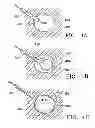 Fig. 07 - Subcutaneous cavity marking device and method