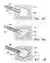 Fig. 08 - Subcutaneous cavity marking device and method