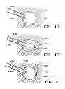 Fig. 09 - Subcutaneous cavity marking device and method