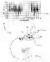 Fig. 01 - Method and device for apnea and hypopnea detection