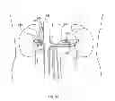 Fig. 07 - METHODS AND DEVICES FOR THERMALLY INDUCED HEPATIC NEUROMODULATION