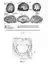 Fig. 10 - Swallowing air pulse therapy mouthpiece and method for the use thereof