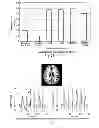 Fig. 12 - Swallowing air pulse therapy mouthpiece and method for the use thereof
